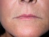 peri oral dermabrasion for smoker's lines