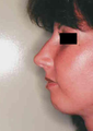 Revision Rhinoplasty