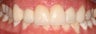 Missing Laterals replaced with dental implants