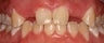 Missing Laterals replaced with dental implants