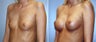Breast Augmentation