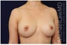 Breast Augmentation