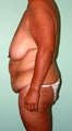 Lower Body Lift: Breast Lift, Crecent Lift, Extended Abdominoplasty