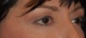 Female with Eyelid Surgery and Brow Lift