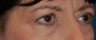 Female with Eyelid Surgery and Brow Lift