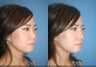 Non-Surgical Rhinoplasty