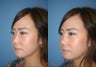 Non-Surgical Rhinoplasty