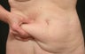 Coolsculpting of Abdomen of 58 year old woman