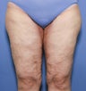 38 year old female treated for thigh laxity following massive weight loss