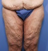 38 year old female treated for thigh laxity following massive weight loss