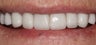 Porcelain Crowns and Porcelain Veneers