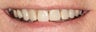 Porcelain Crowns and Porcelain Veneers