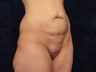 39 Year Old After Gastric Bypass