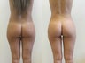 Brazilian butt lift