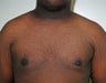 Adult Male treated for Breast Reduction
