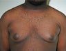 Adult Male treated for Breast Reduction