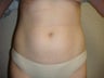 Liposuction