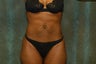 Women's Tummy Tuck