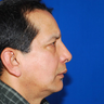 Rhinoplasty