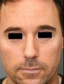 Male Primary Rhinoplasty