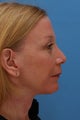 Patient Concerned with Neck Aging