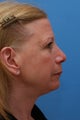 Patient Concerned with Neck Aging