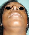 a 36 year old female treated with Rhinoplasty