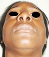 a 36 year old female treated with Rhinoplasty