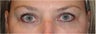 Restylane