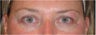 Restylane