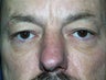 lower blepharoplasty in a male