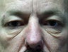 lower blepharoplasty in a male