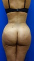 Brazilian Butt Lift