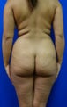 Brazilian Butt Lift