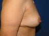 Breast Lift