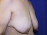 Breast Lift