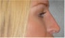Non Surgical Nose Job