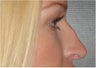 Non Surgical Nose Job