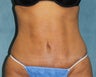 Mini-Tummy Tuck