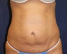Mini-Tummy Tuck