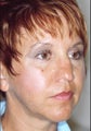 Revision rhinoplasty