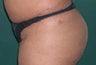 Buttock Augmentation With Fat Transfer