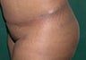 Buttock Augmentation With Fat Transfer