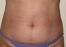 truSculpt
