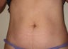 truSculpt