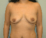 38 Year Old Female with Saline Breast Augmentation and Benelli Mastopexy (Lift)