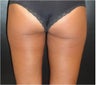 SmartLipo