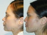 Asian Nose Surgery
