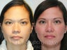 Asian Nose Surgery
