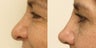 Revision rhinoplasty in a 50 year old client